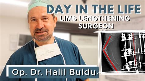 ameliyat ve son. . Dr halil buldu limb lengthening cost